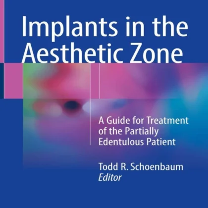 Implants in the Aesthetic Zone: A Guide for Treatment of the Partially Edentulous Patient