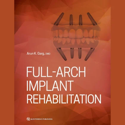 Full-Arch Implant Rehabilitation