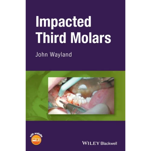 Impacted Third Molars