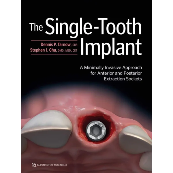 The Single-Tooth Implant The Single-Tooth Implant