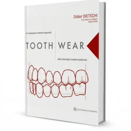 Tooth Wear: Interceptive Treatment Approach With Minimally Invasive Protocols
