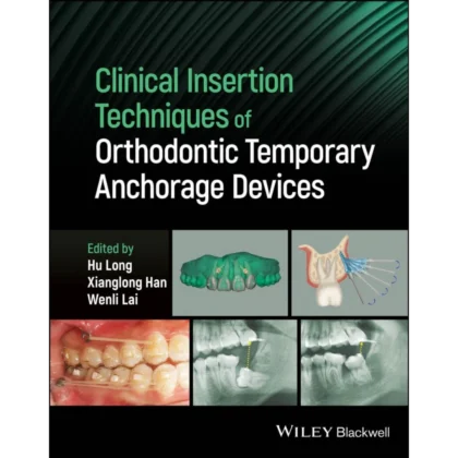 Clinical Insertion Techniques of Orthodontic Temporary Anchorage Devices